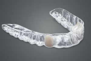 Essix retainer