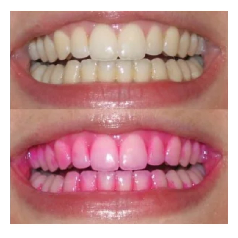 Plaque Disclosing Effect - Before and After